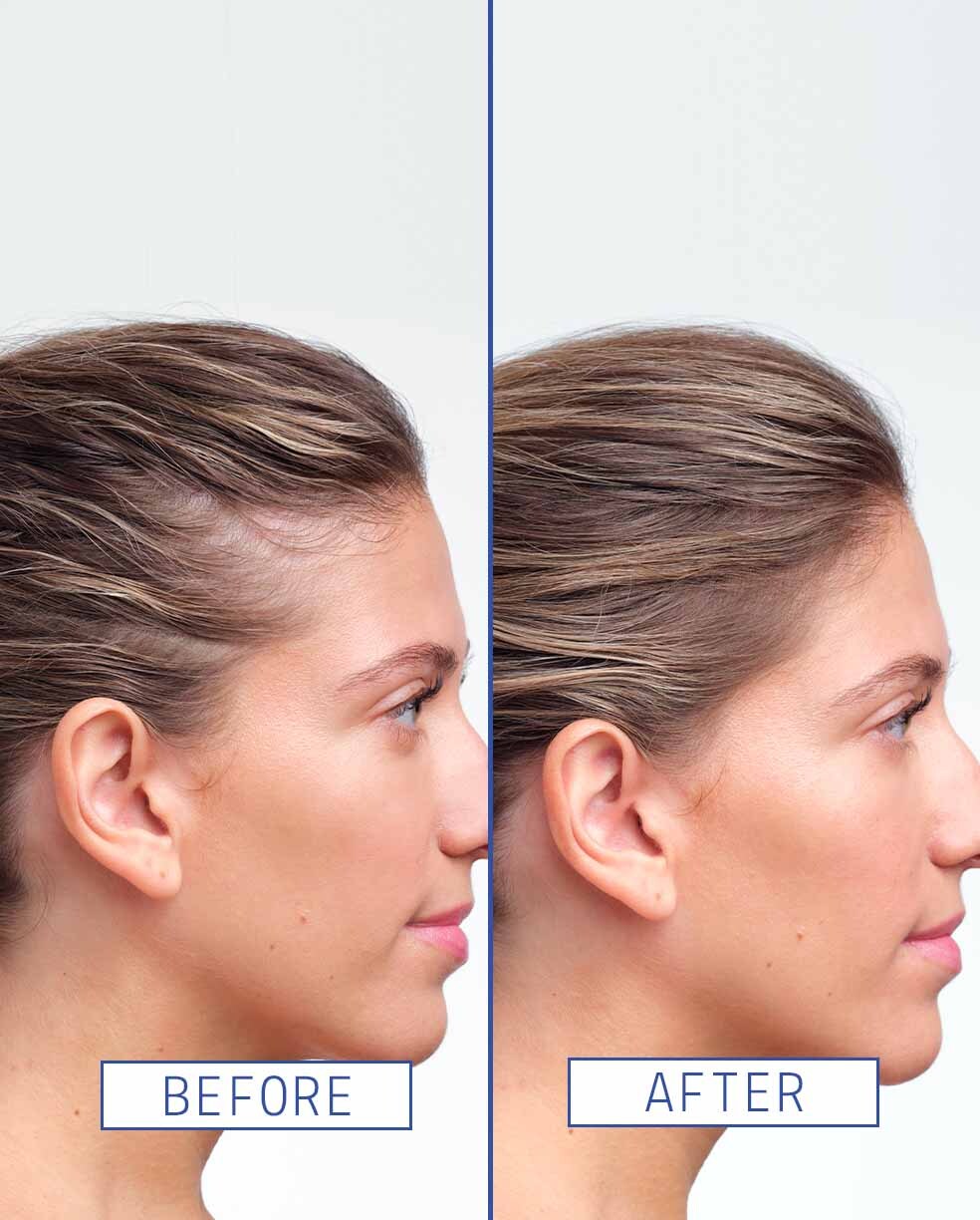AAVRANI Hair Density Boosting Treatment  Before and After