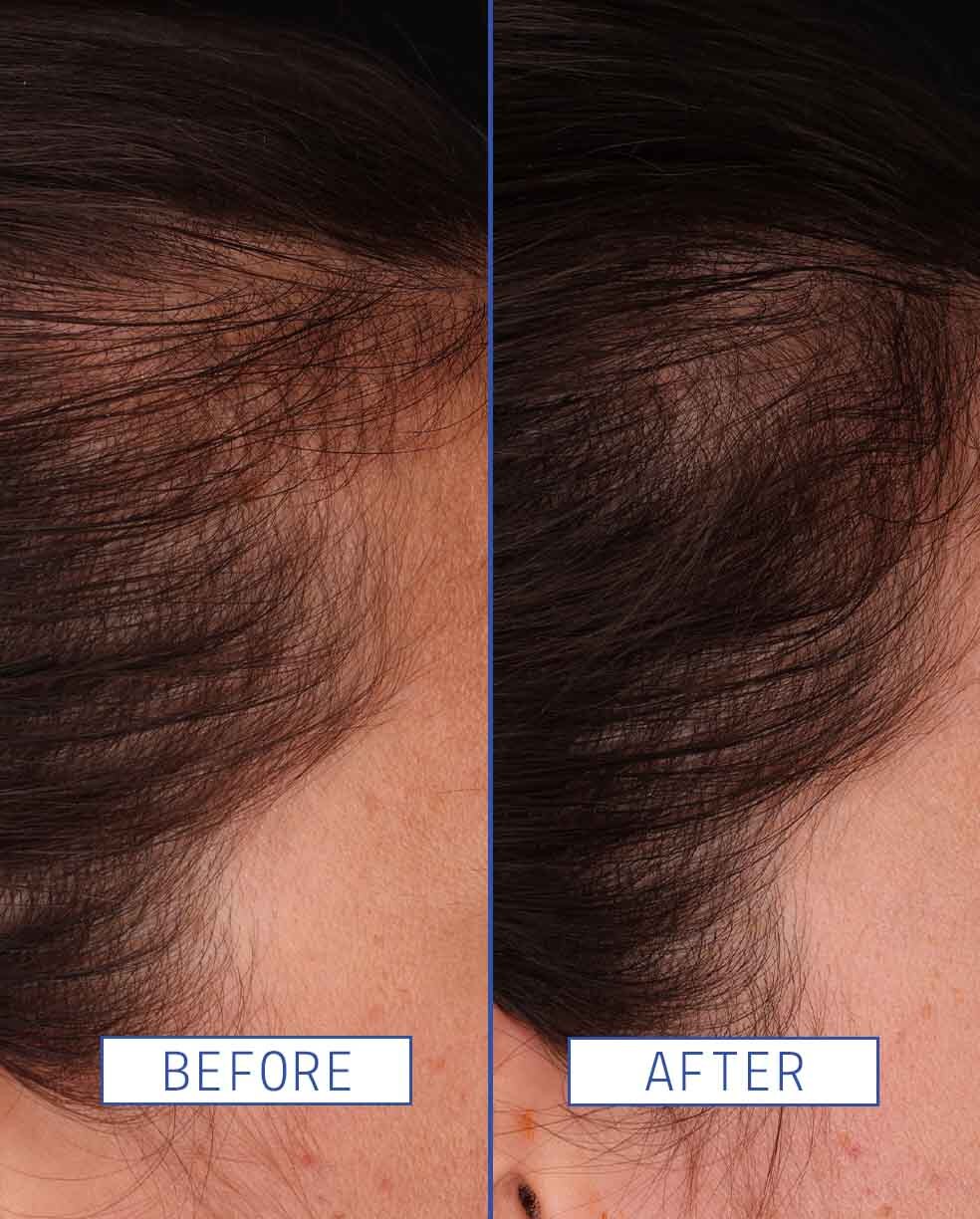 AAVRANI Hair Density Boosting Treatment Before and After
