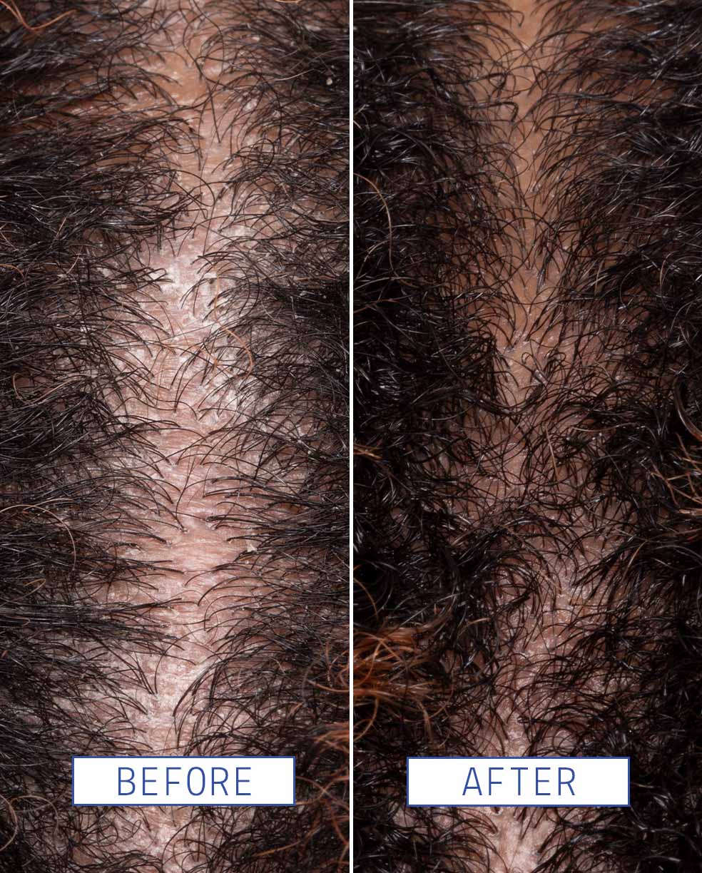 Close-up shot of a scalp before using Scalp Detox Jelly Cleanser and after using Scalp Detox Jelly Cleanser