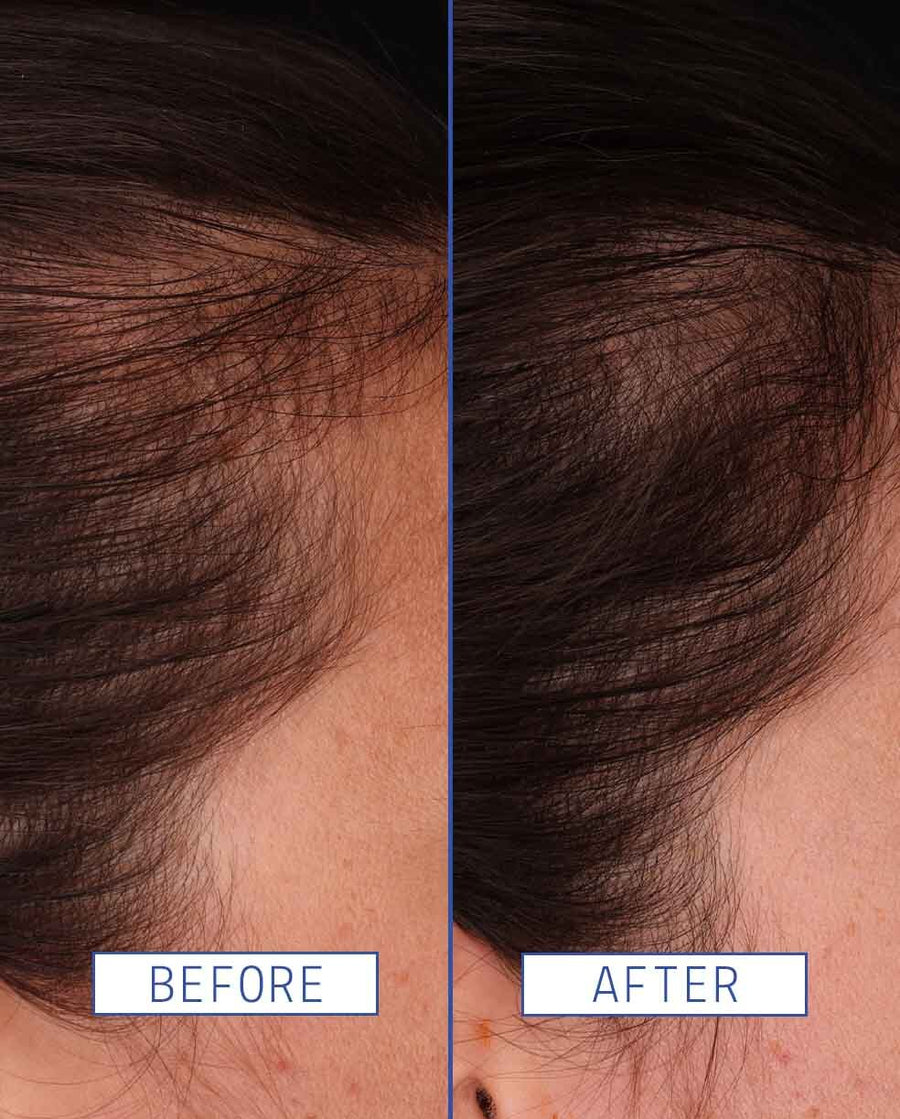 Hair Density Growth Serum for Thinning Hair | AAVRANI