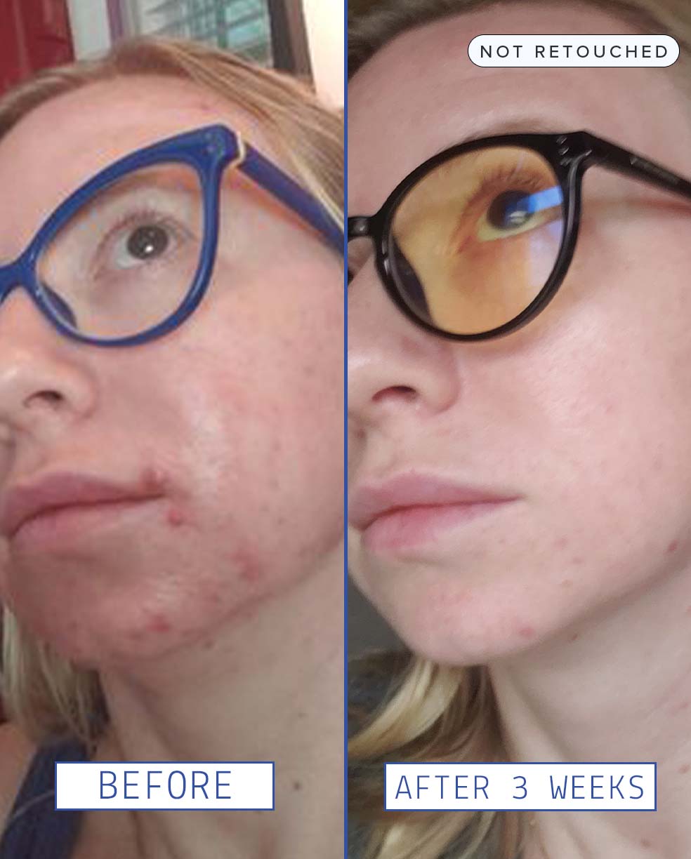 Before and after 3 weeks, blonde woman with glasses, blemish free after 3-weeks.